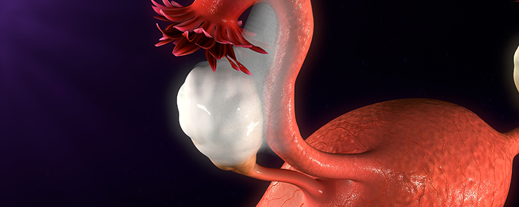 endometriosis2