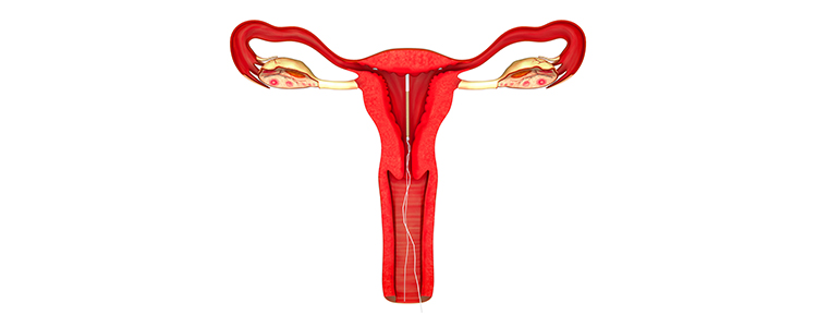 intrauterine-insemination1
