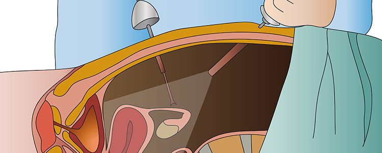laparoscopy-2
