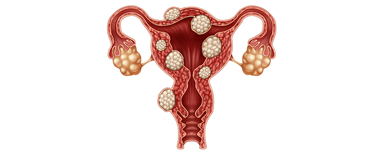 myomectomy-(Fibroid)2