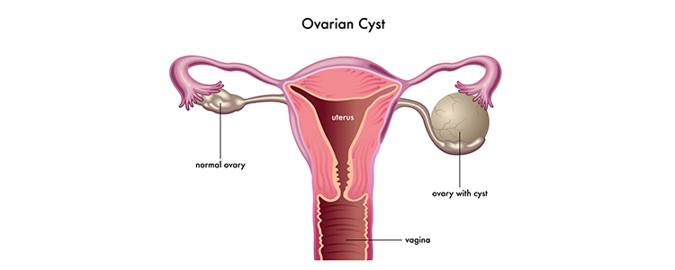 ovarian-cyst2
