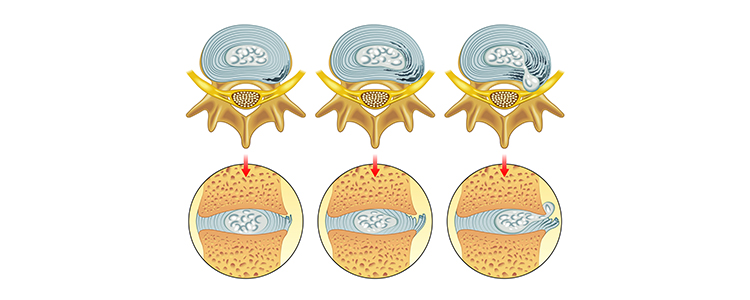 uterine2